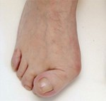Reumatische voet